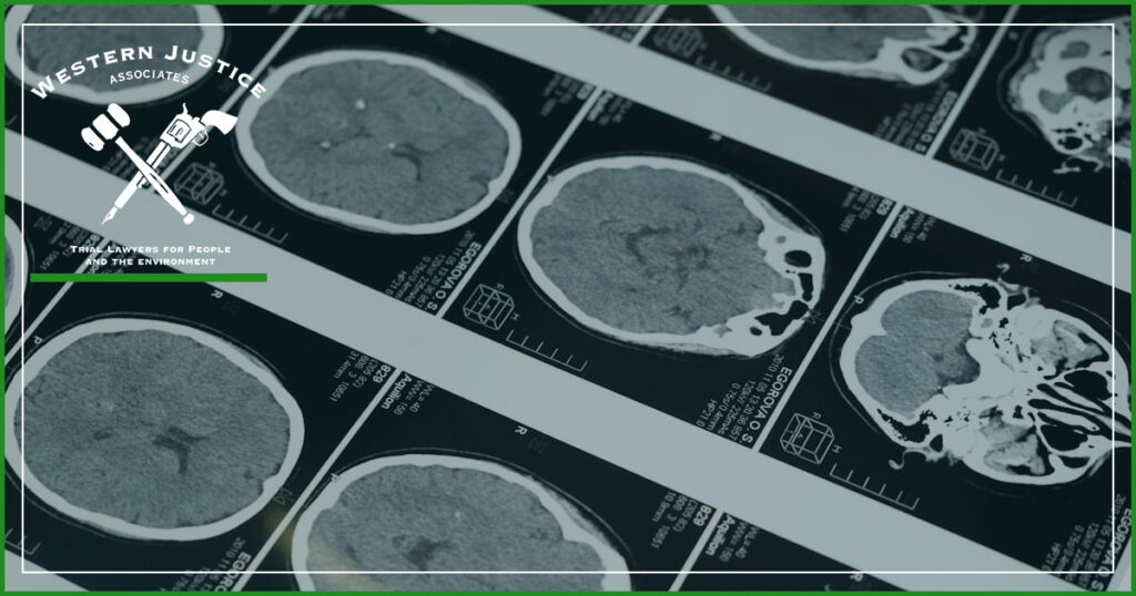 What Is the Average Settlement for a Traumatic Brain Injury?